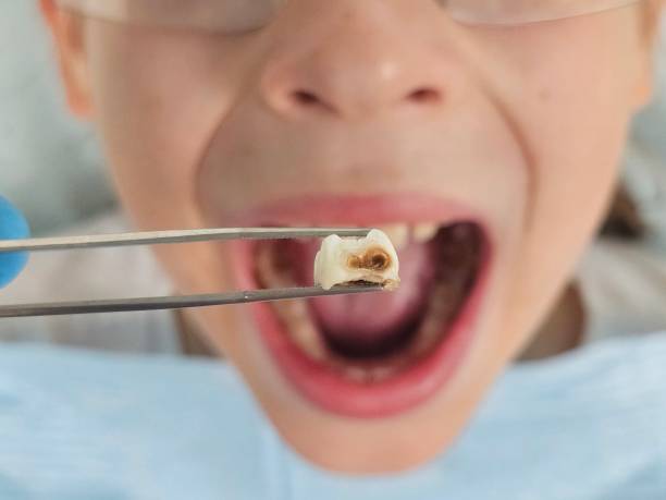 Best Emergency Wisdom Teeth Removal in Kelseyville, CA